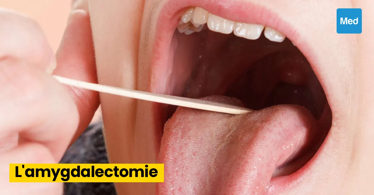 Comprendre l'amygdalectomie: Quand et pourquoi cette intervention est-elle nécessaire ?